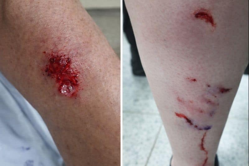 Ataque de pitbulls deixa dois jovens feridos em Cesário Lange e reacende alerta - Cidade em Cesário Lange
