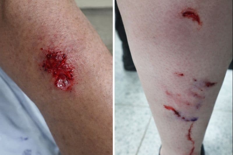 Ataque de pitbulls deixa dois jovens feridos em Cesário Lange e reacende alerta - Cidade em Cesário Lange